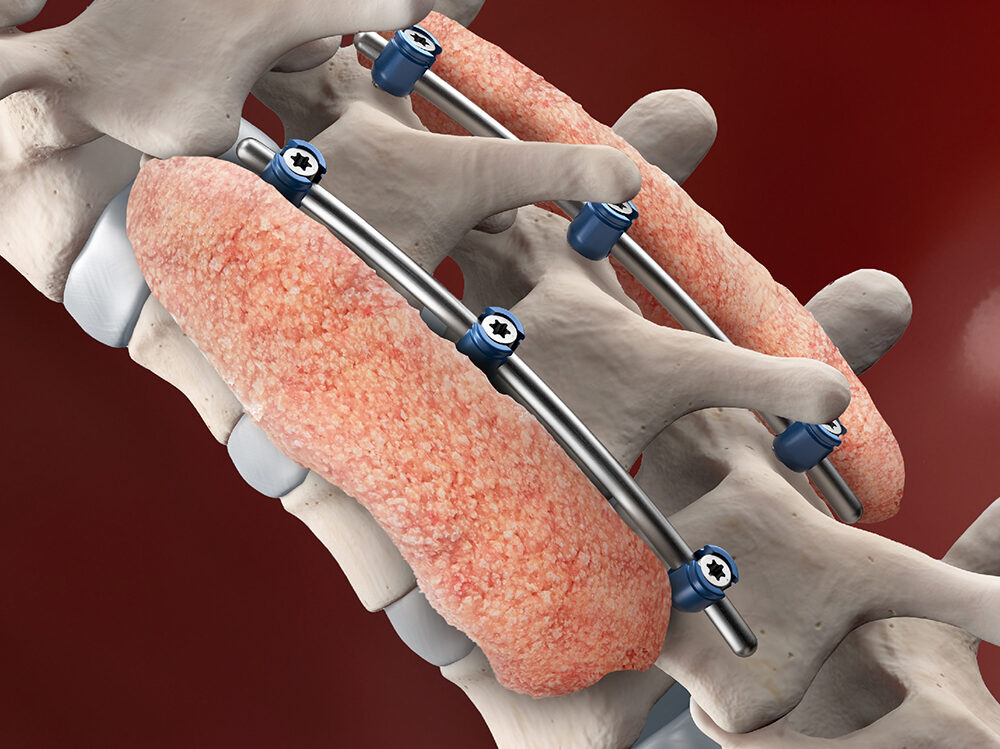 Spine Bone Graft_0